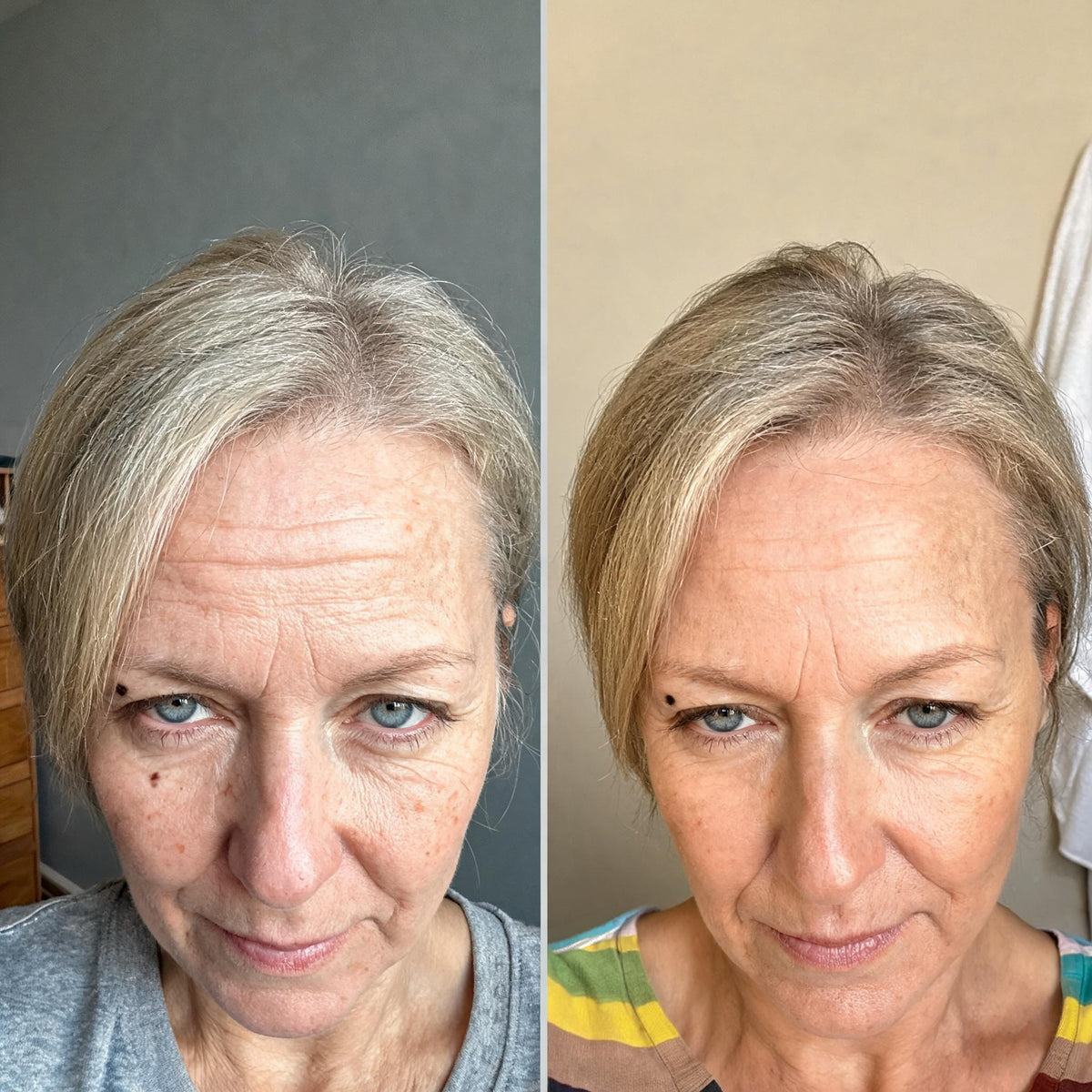 Before and after skin comparison showing improved skin condition and texture