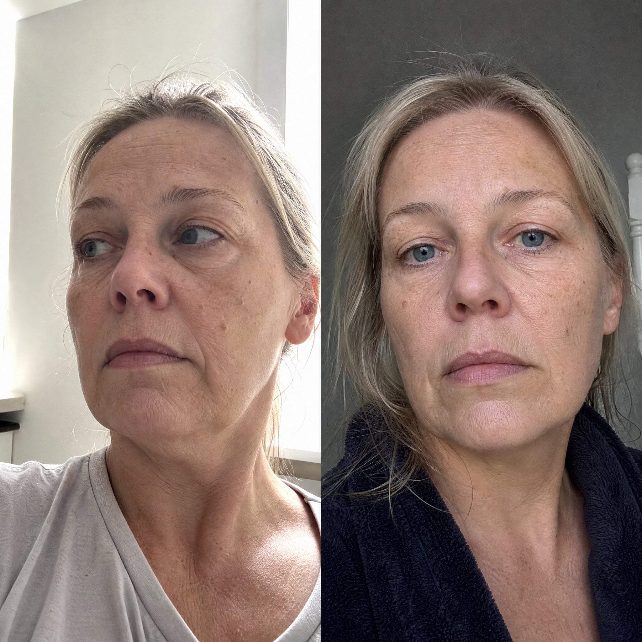 Before and after skin comparison showing improved skin condition and texture