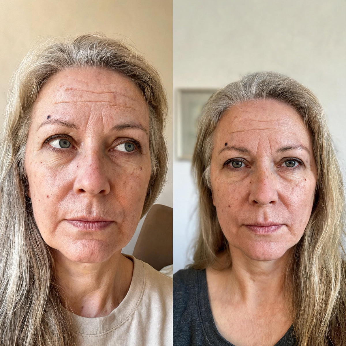 Before and after skin comparison showing improved skin condition and texture