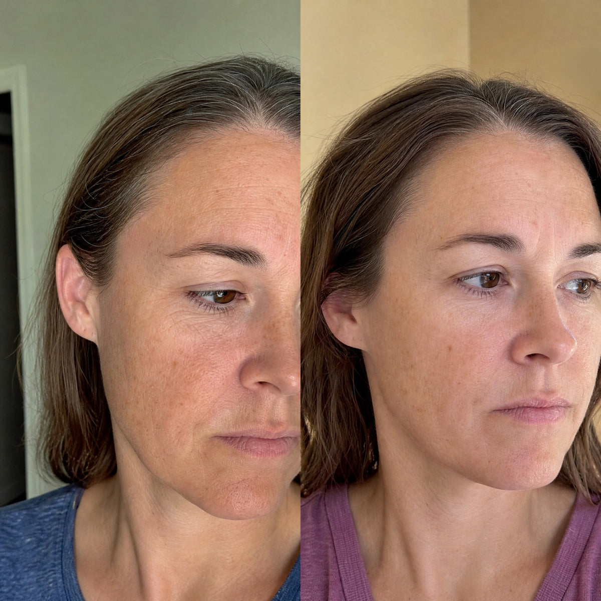 Before and after skin comparison showing softer fine lines and wrinkles