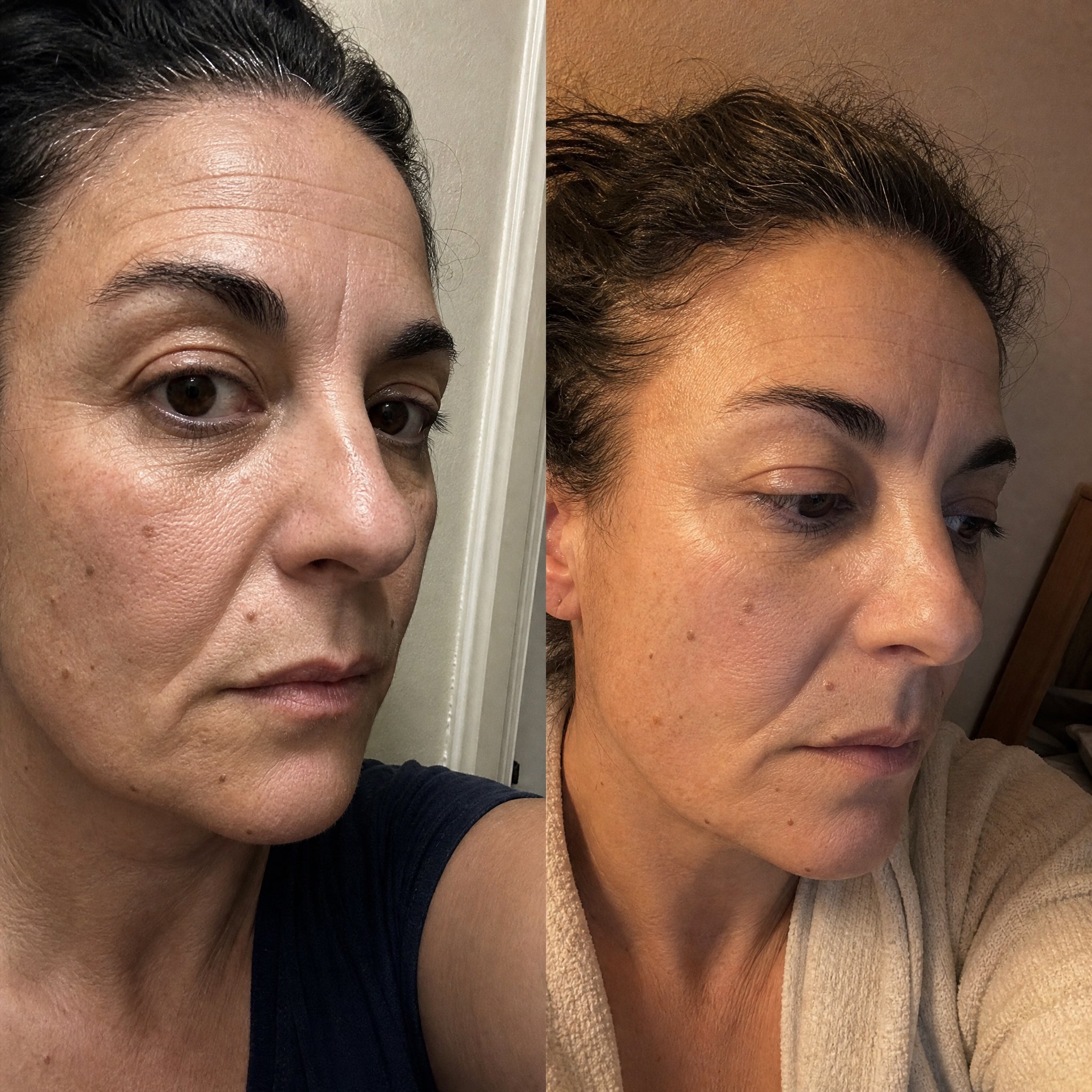 Before and after skin comparison showing softer fine lines and wrinkles