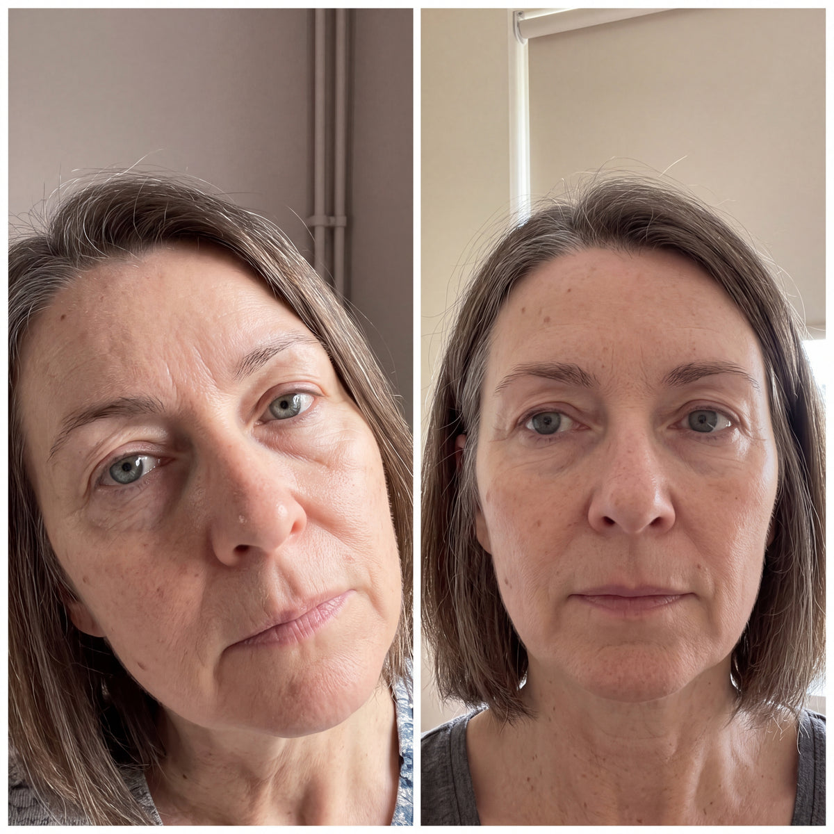 Before and after photographs from a Skingenetix customer, showing nasolabial and under-eye smoothing