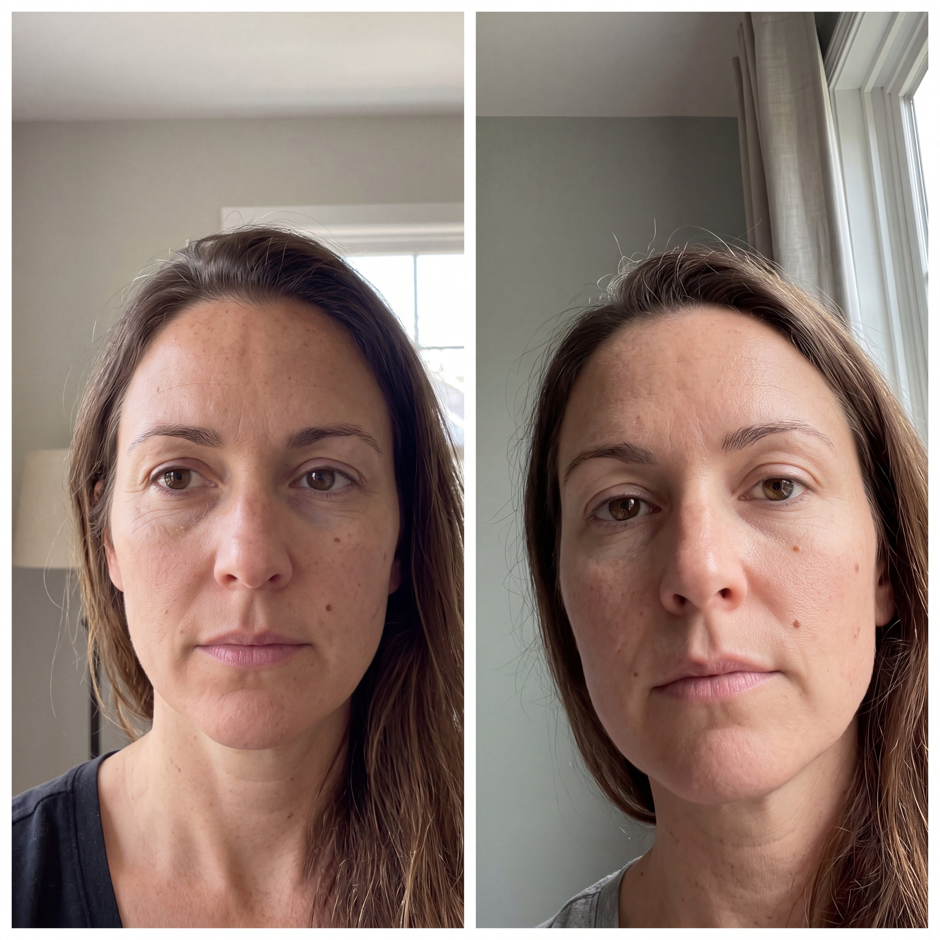 Before and after photographs from a Skingenetix customer, showing mid-face lines and overall smoothness