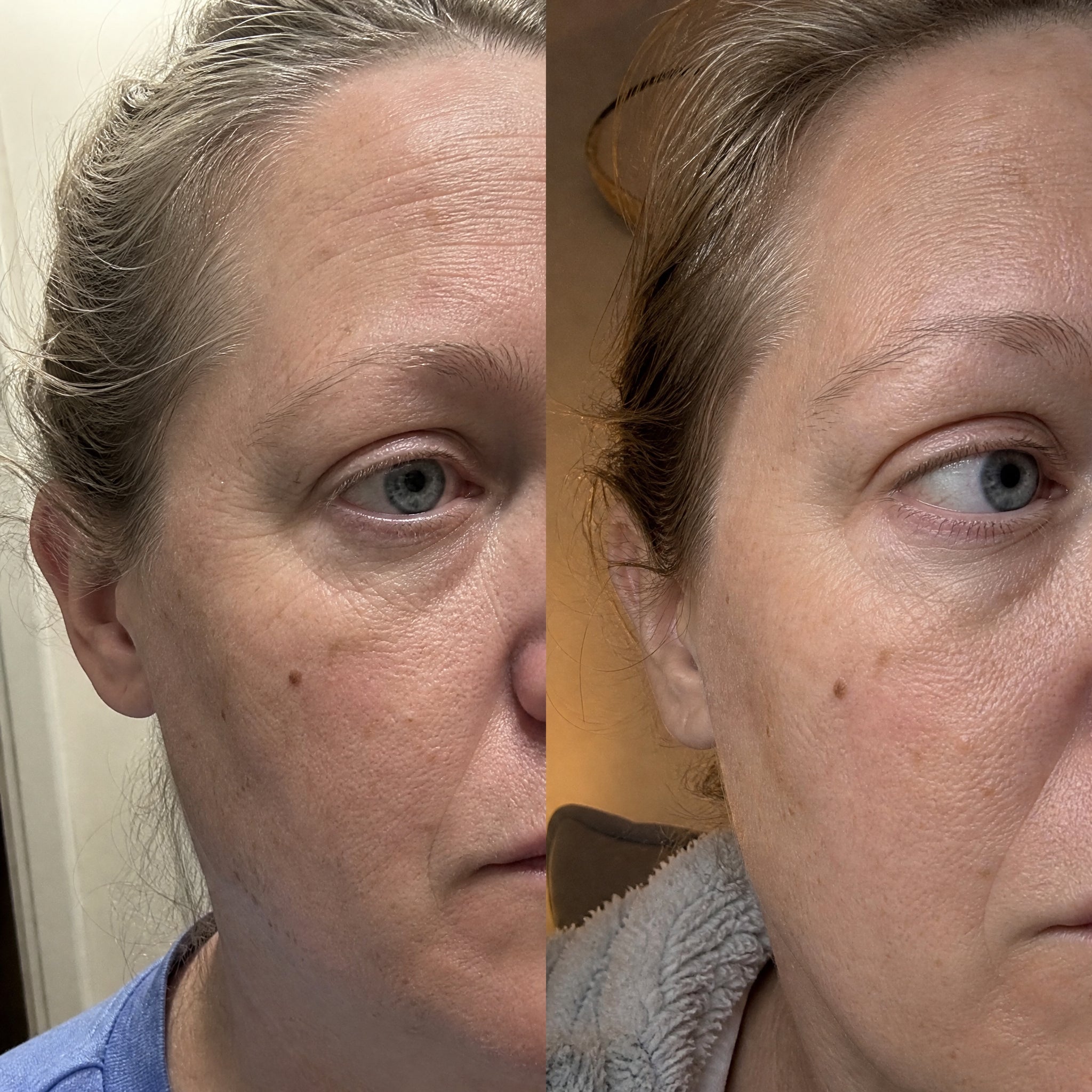 Before and after skin comparison showing softer fine lines and wrinkles