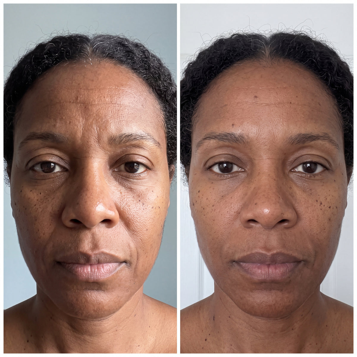 Before and after skin comparison showing softer fine lines and wrinkles