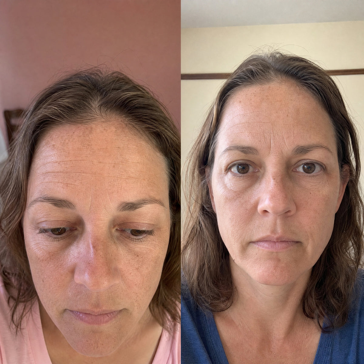 Before and after skin comparison showing softer fine lines and wrinkles