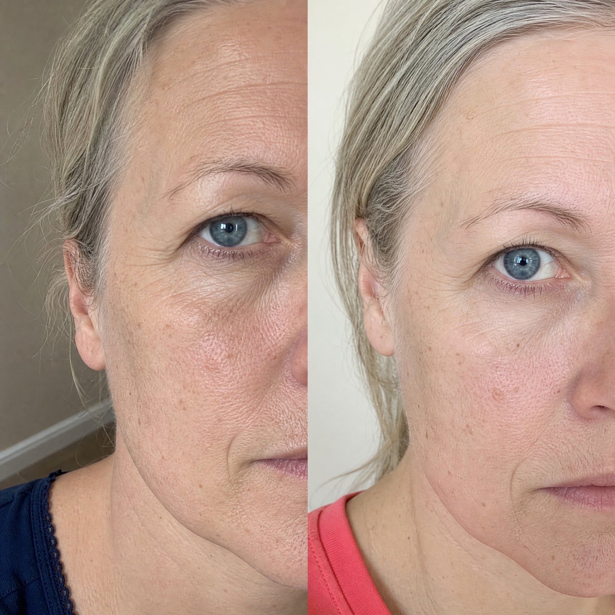 Before and after skin comparison showing softer fine lines and wrinkles