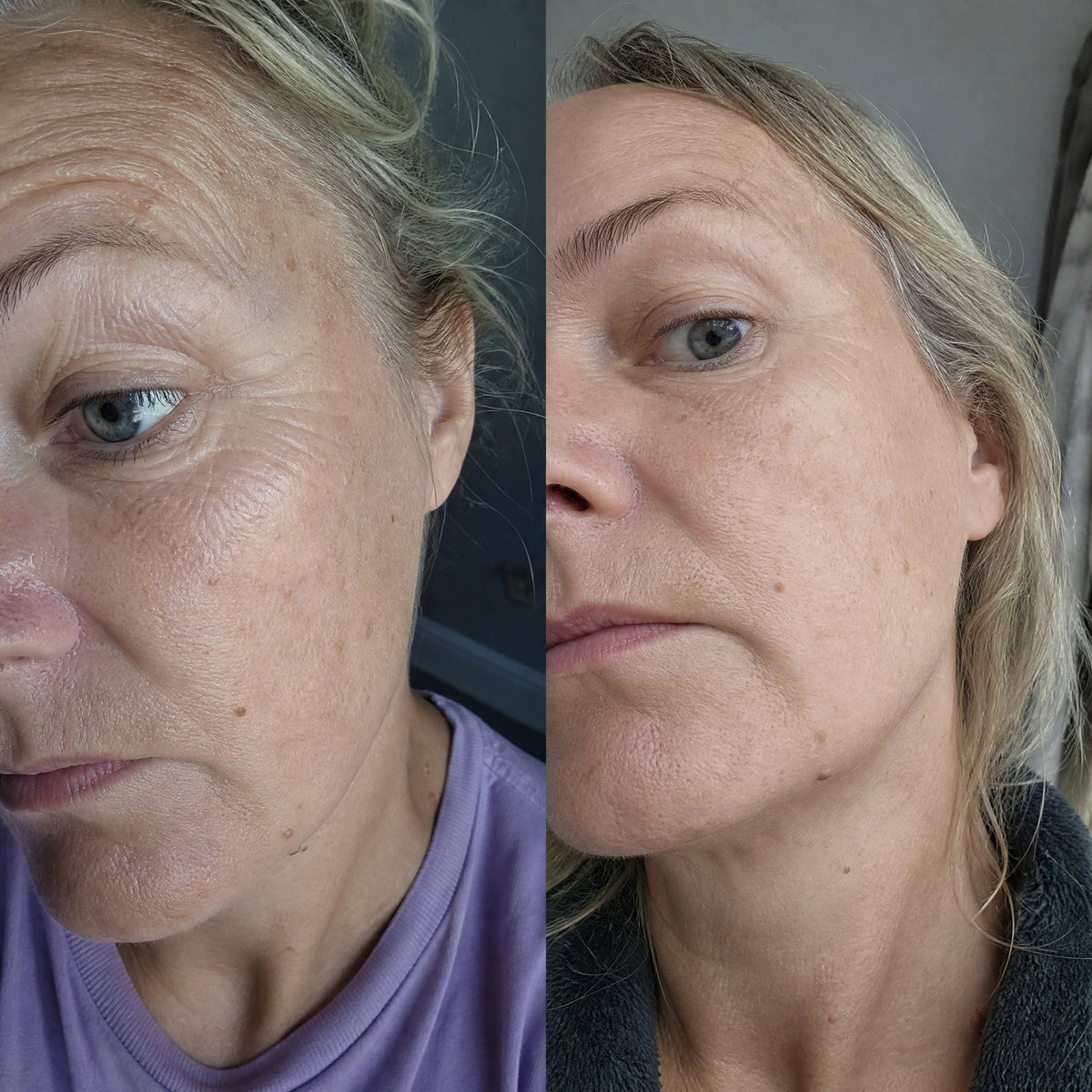 Before and after skin comparison showing softer fine lines and wrinkles