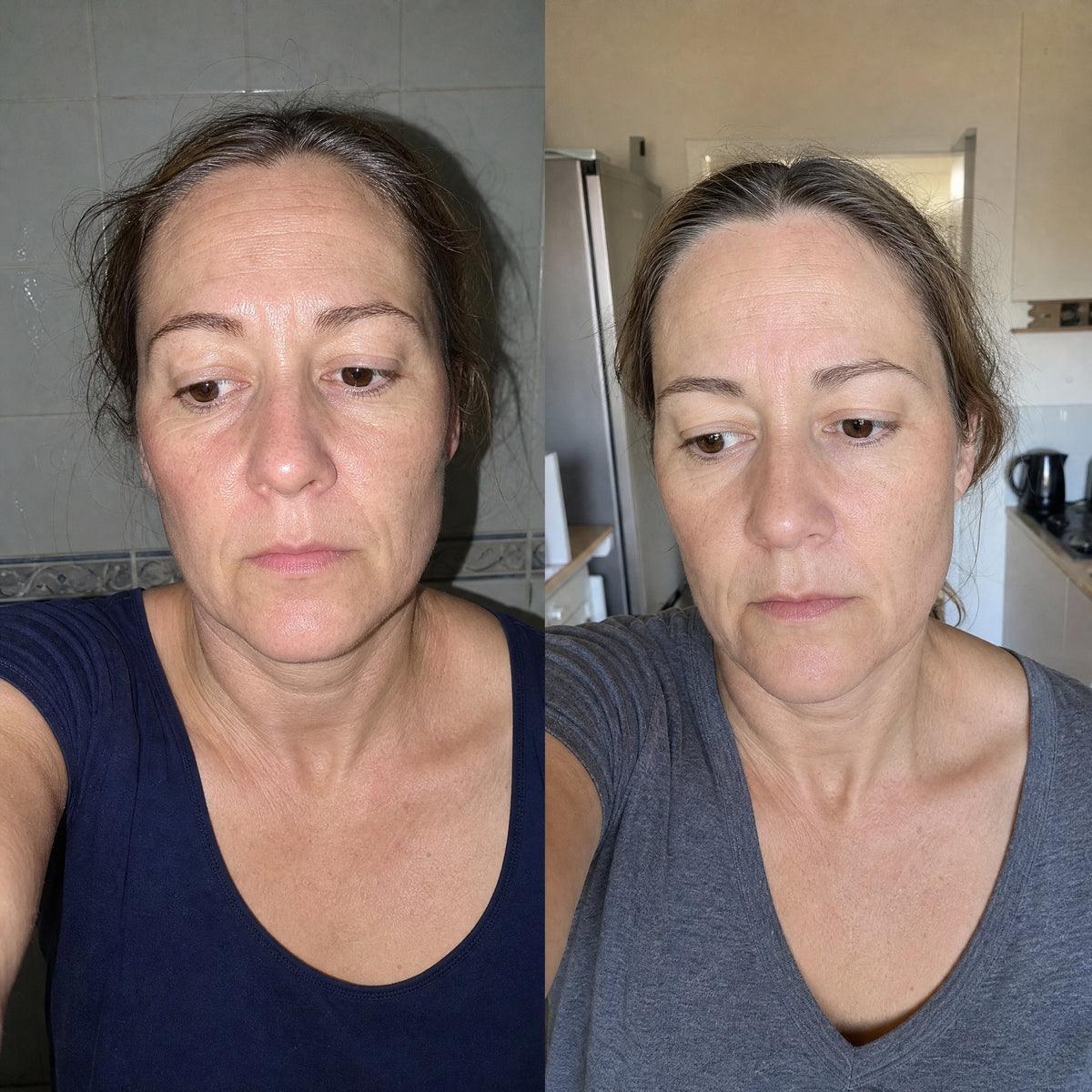 Before and after photographs from a Skingenetix customer, showing nasolabial and marionette lines softening