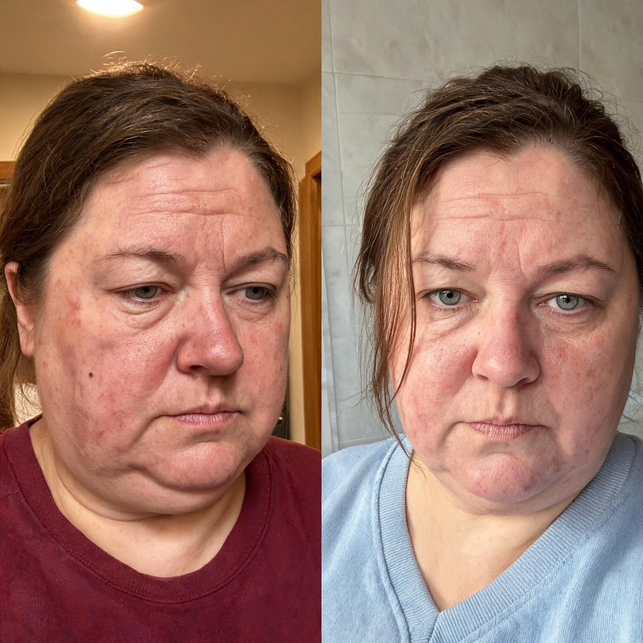 Before and after photographs from a Skingenetix customer, showing pronounced facial redness calming