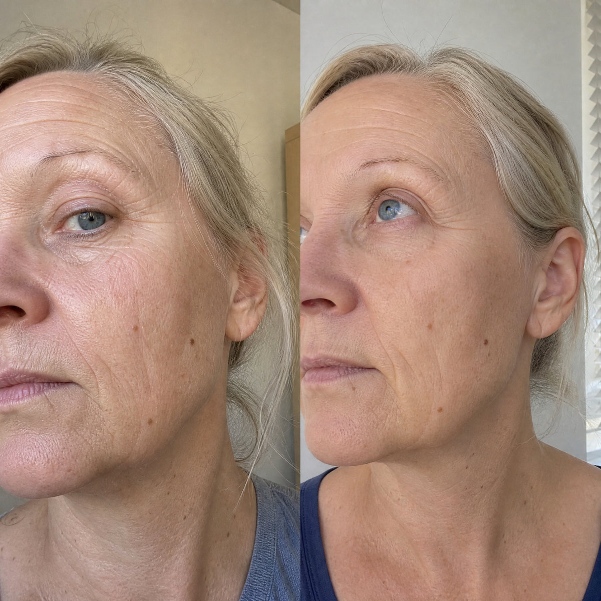 Before and after skin comparison showing softer fine lines and wrinkles
