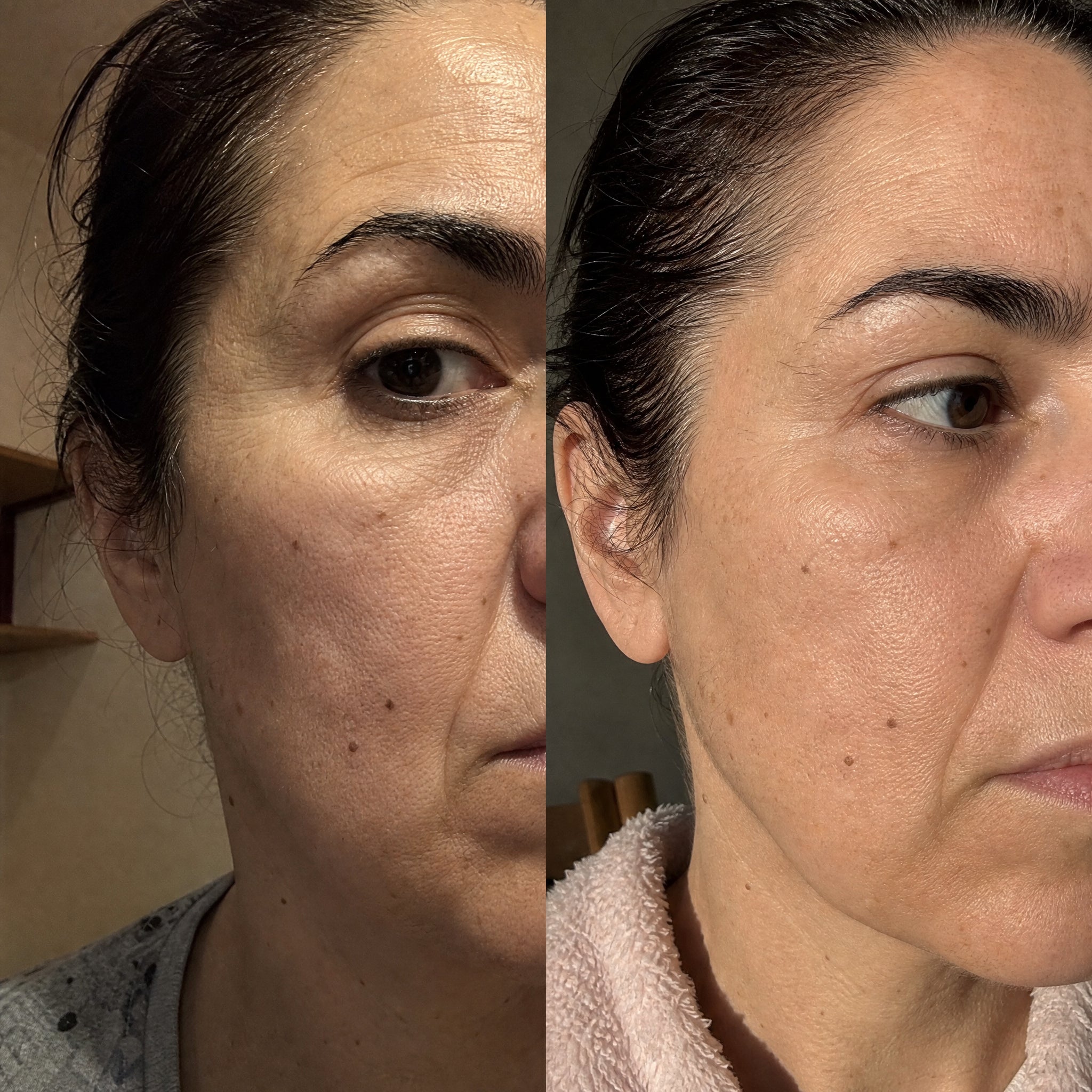 Before and after skin comparison showing softer fine lines and wrinkles