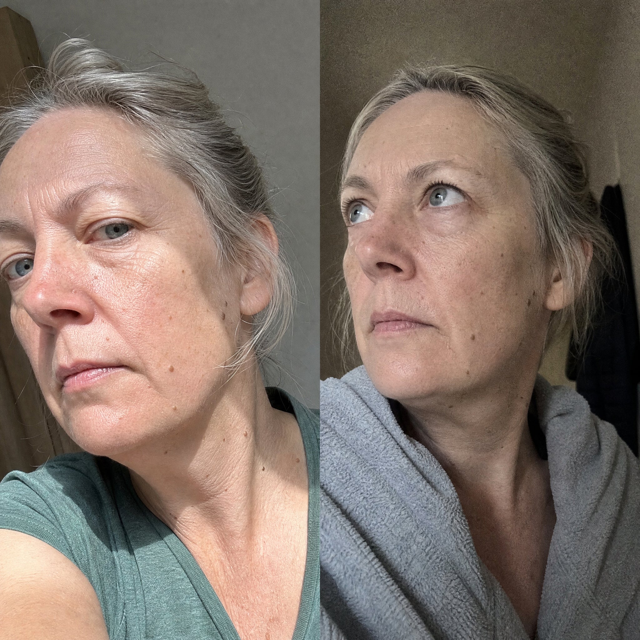 Before and after skin comparison showing softer fine lines and wrinkles