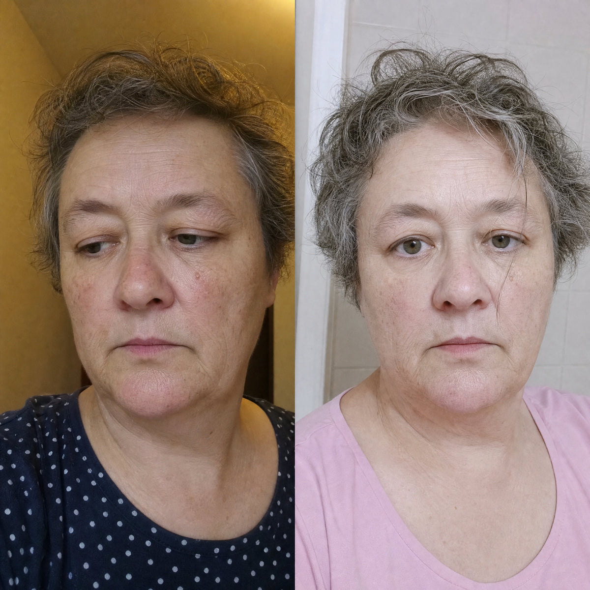 Before and after photographs from a Skingenetix customer, showing overall texture on mature skin