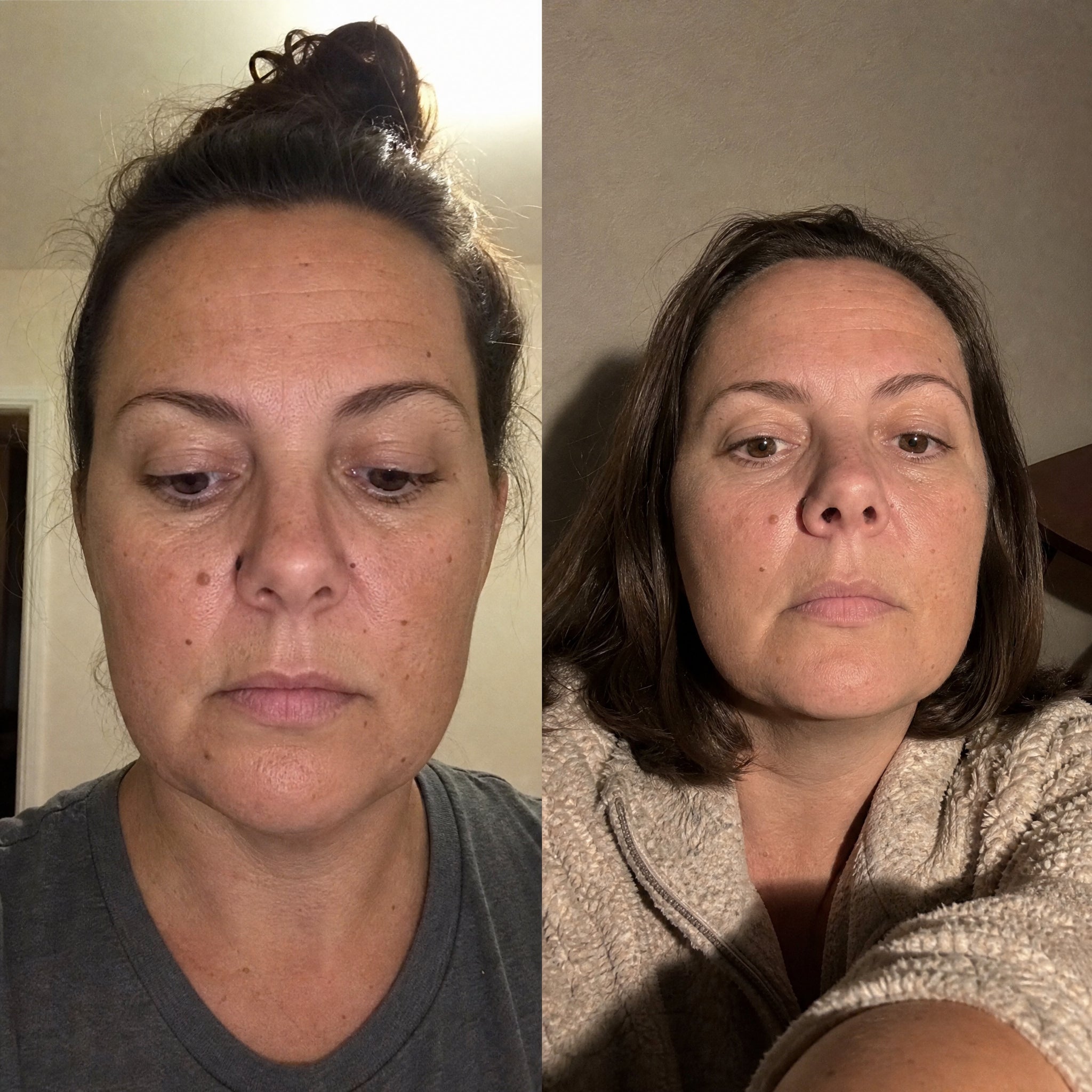 Before and after skin comparison showing softer fine lines and wrinkles