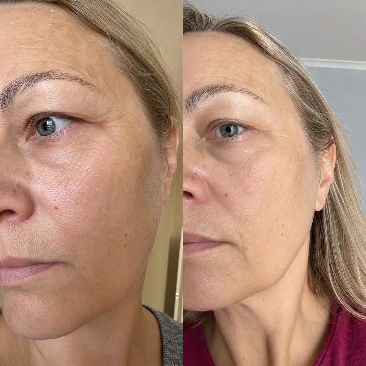 Before and after skin comparison showing softer fine lines and wrinkles